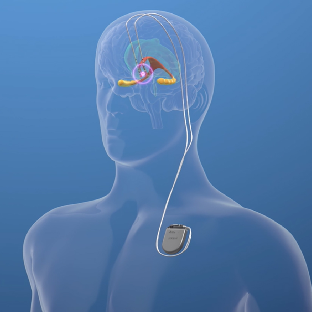 İzmir Deep Brain Stimulation and Programming | Dr. Tuğba KORKMAZ